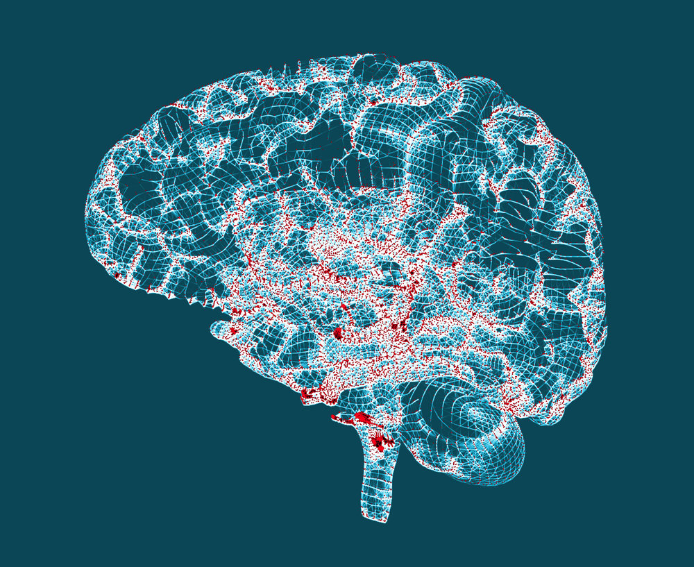 alzheimersdi